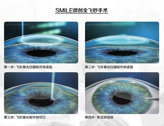 蔡司全飛秒、蔡司半飛秒近視手術(shù)與蔡司全飛秒flex手術(shù)