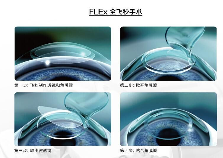蔡司全飛秒、蔡司半飛秒近視手術(shù)與蔡司全飛秒flex手術(shù)