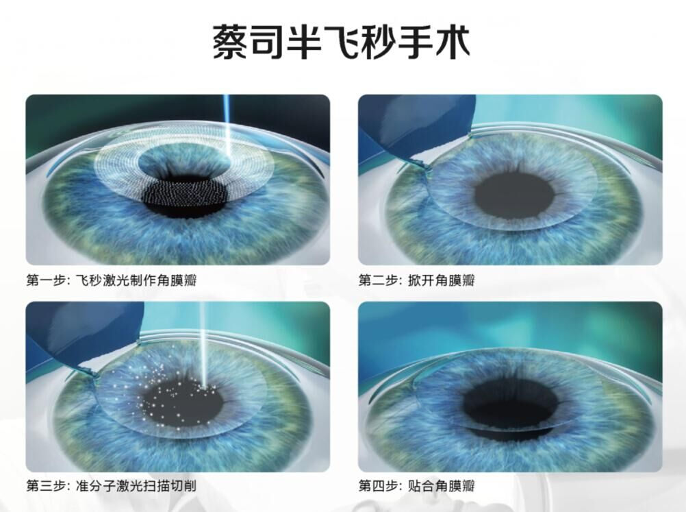 蔡司全飛秒、蔡司半飛秒近視手術(shù)與蔡司全飛秒flex手術(shù)