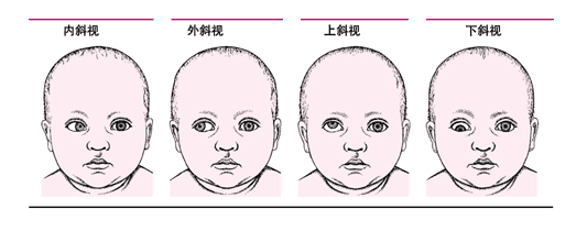 蘭州兒童眼病專(zhuān)家：孩子常常歪脖子可能是斜視