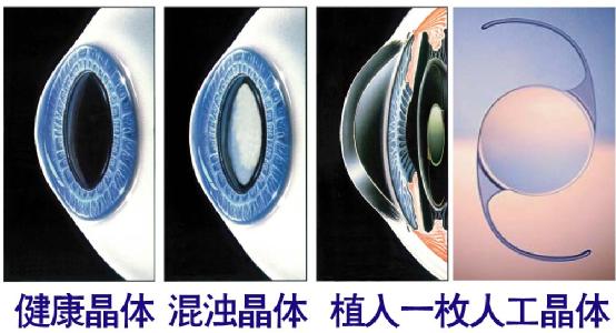 超聲乳化手術(shù)白內(nèi)障危險(xiǎn)嗎？