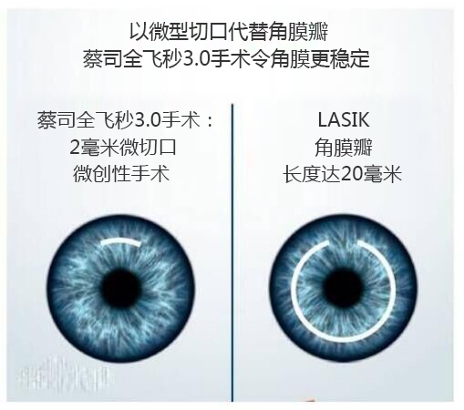 做完近視手術(shù)要休息多長時間？需要住院嗎？