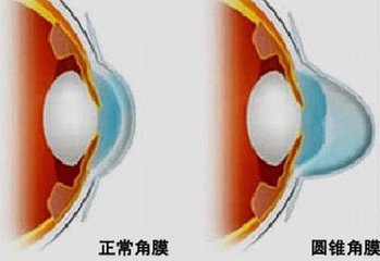 圓錐角膜，哪種角膜移植術(shù)好？