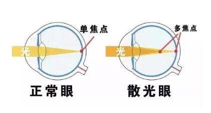 近視和散光，手術能同時矯正嗎？