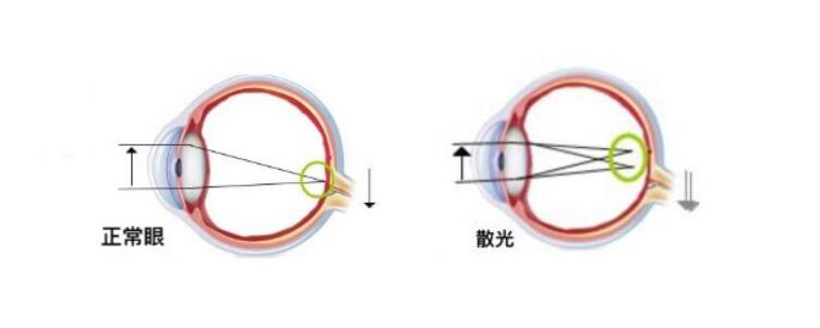 高度散光加近視可以做手術(shù)嗎？